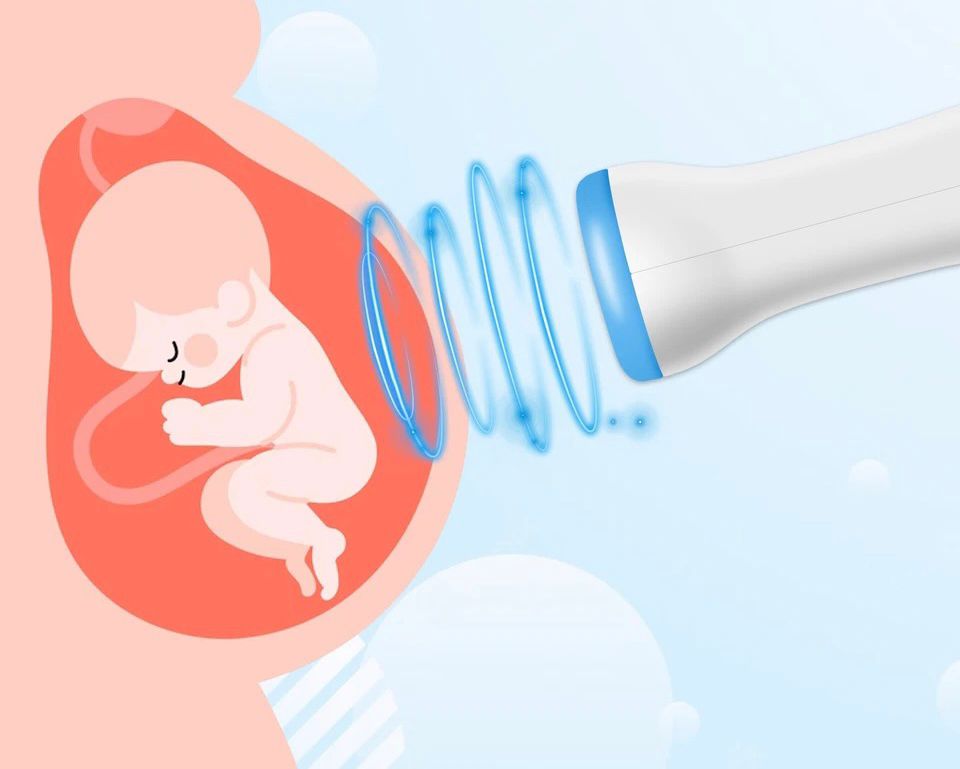 FETALNI DOPPLER (VARUŠKA) DOMAČI ULTRAZVOK ZA NOSEČNICE